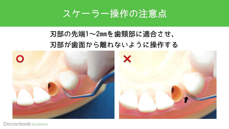 歯周基本治療 トータルから口をみる 歯周病｜【公式】関口デンタルオフィス埼玉｜さいたま市北区宮原